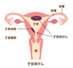 nhcl 子宮　子宮内膜
